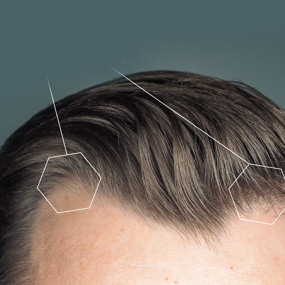 robotic hair microneedling