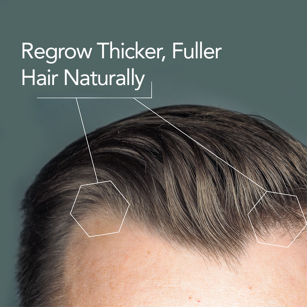 regrow_hair_naturally