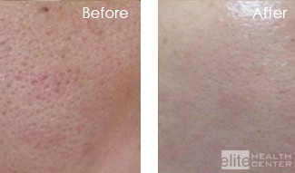 vivace reduces pores